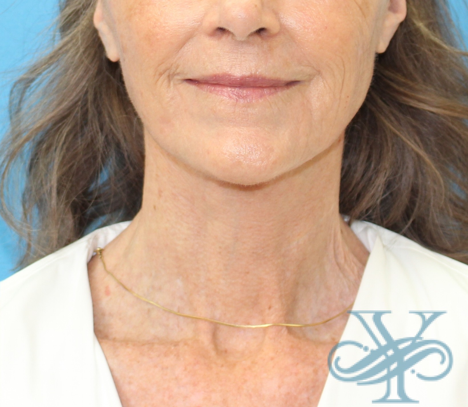 After necklift Dr. Yegiyants, Santa Barbara, CA