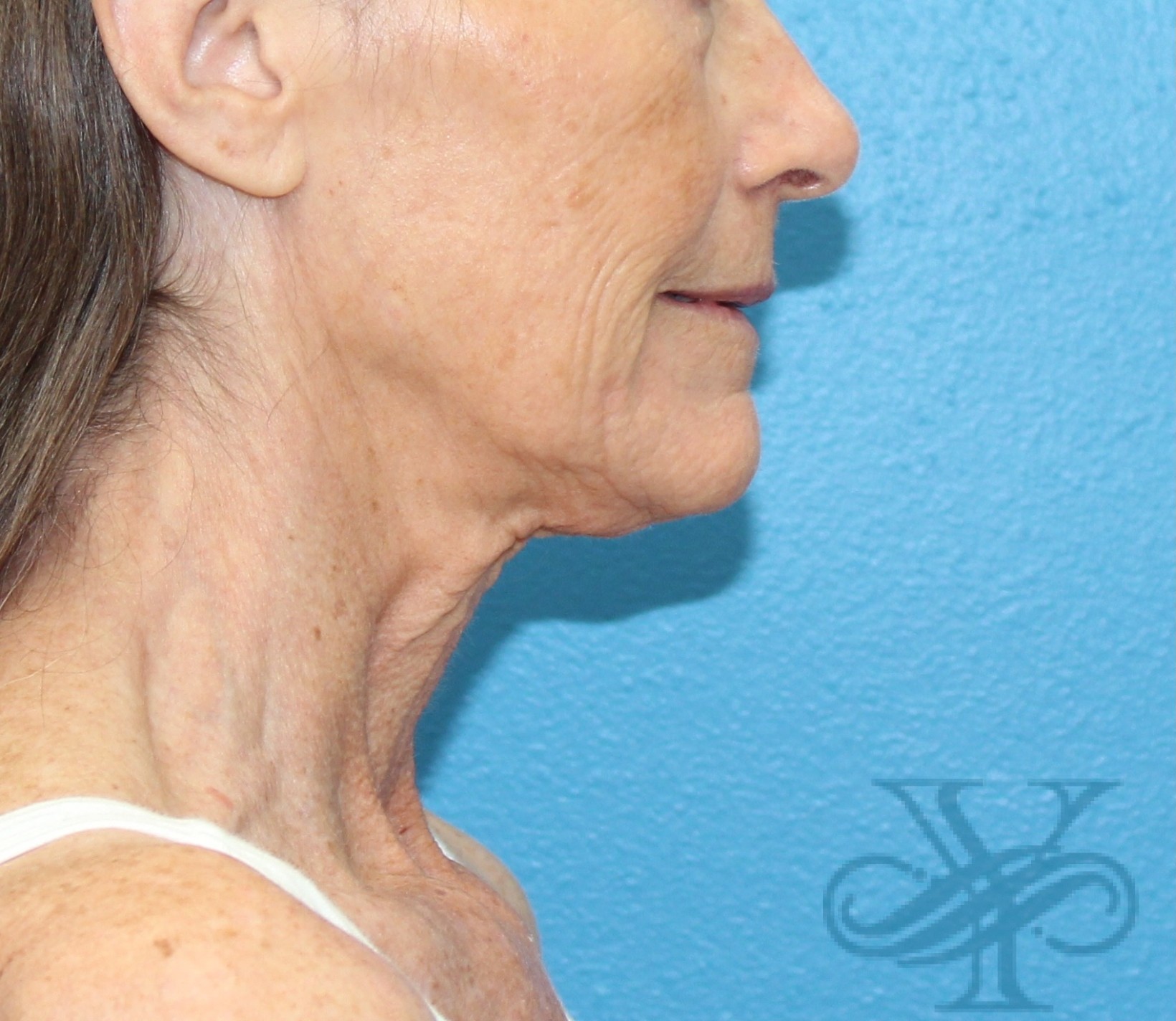 Before necklift Dr. Yegiyants, Santa Barbara, CA