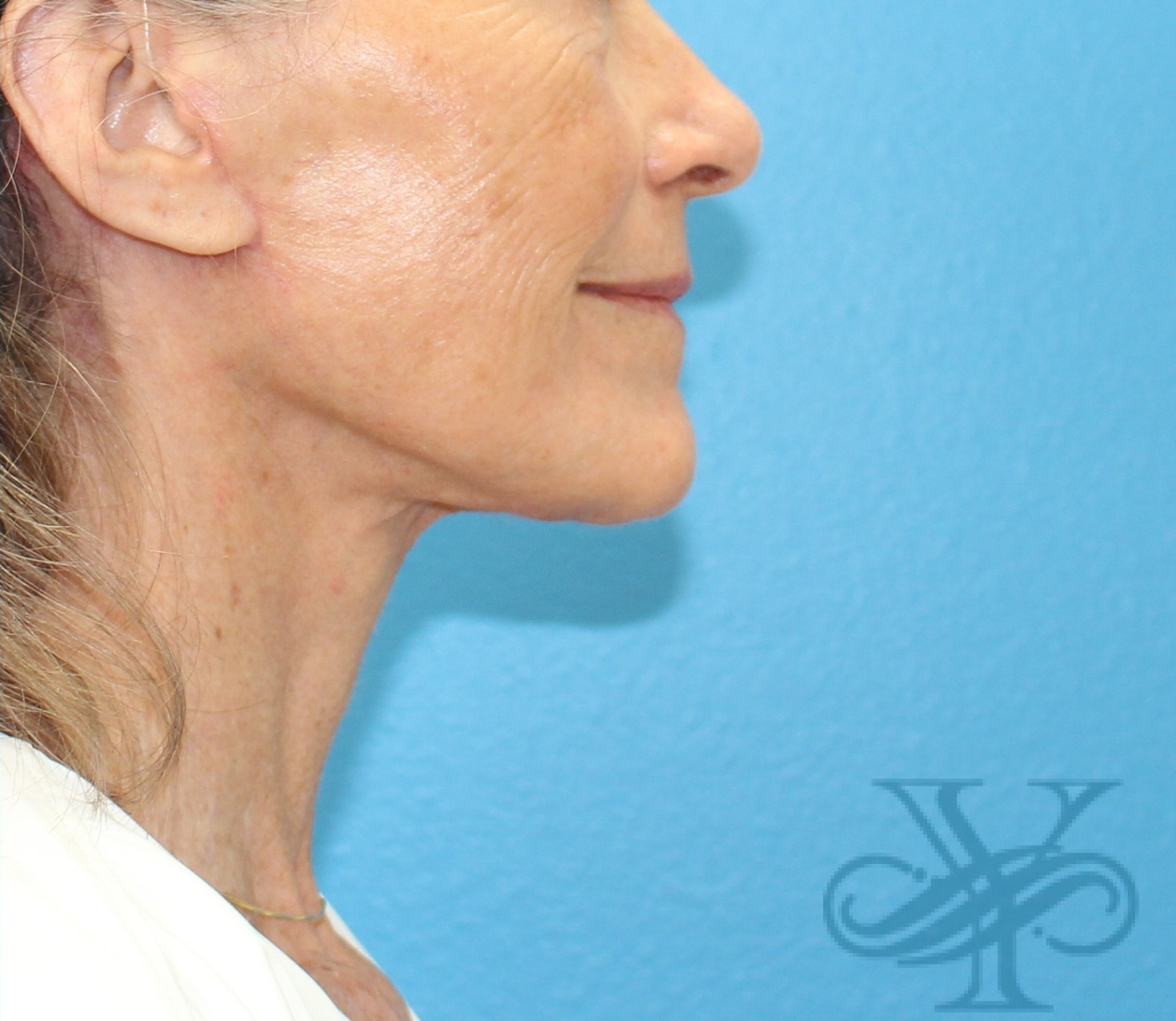 After necklift Dr. Yegiyants, Santa Barbara, CA