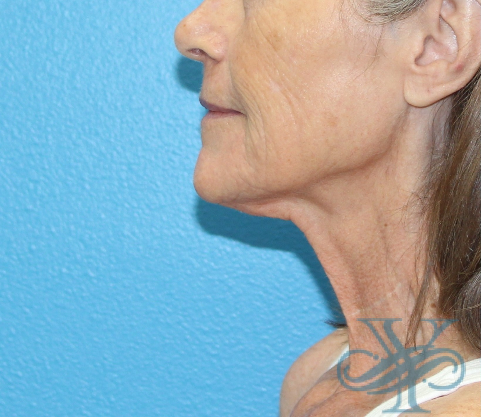 Before necklift Dr. Yegiyants, Santa Barbara, CA