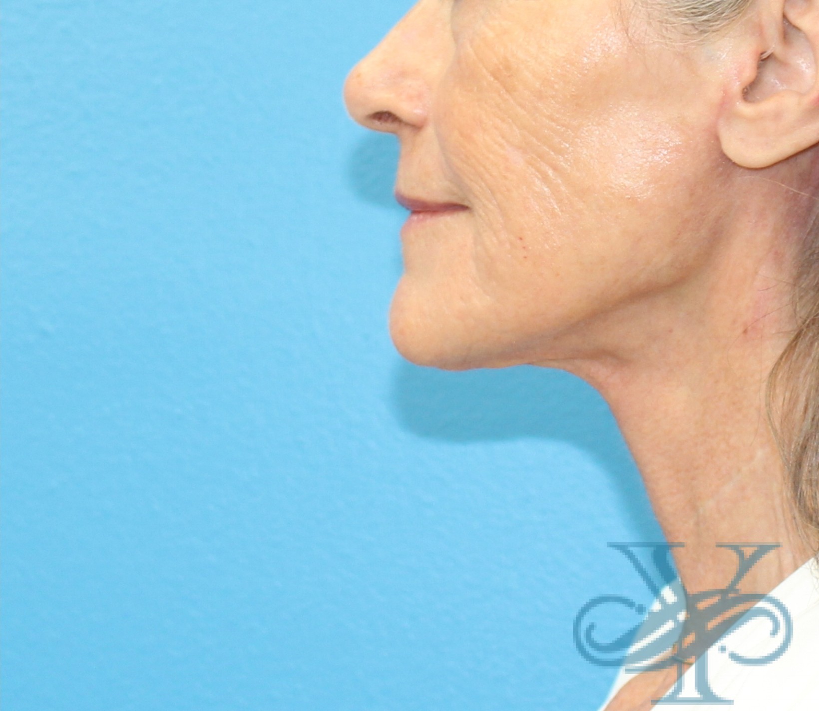After necklift Dr. Yegiyants, Santa Barbara, CA