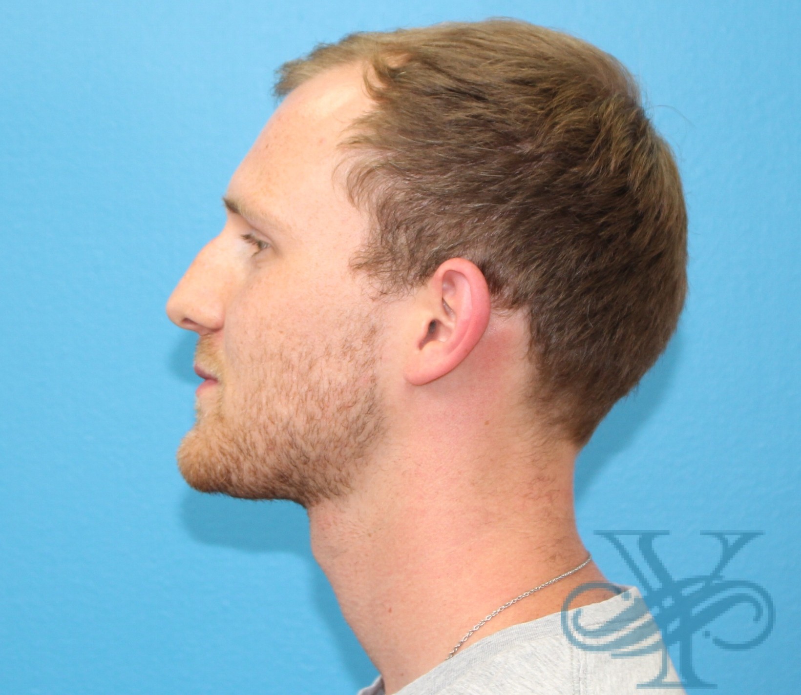 After rhinoplasty Dr. Yegiyants, Santa Barbara, CA