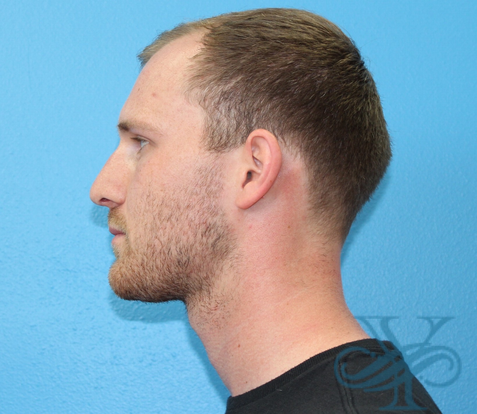 After rhinoplasty Dr. Yegiyants, Santa Barbara, CA