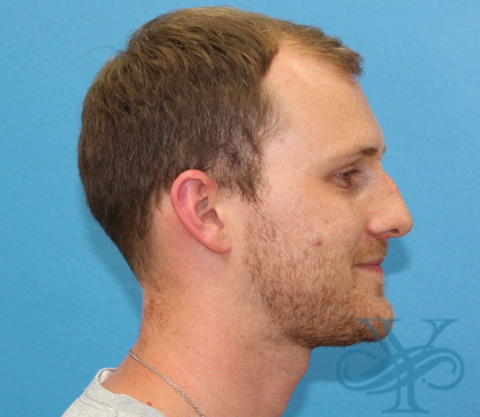 Before rhinoplasty Dr. Yegiyants, Santa Barbara, CA