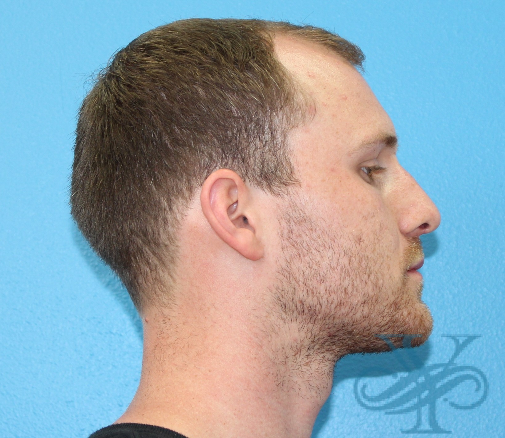 After rhinoplasty Dr. Yegiyants, Santa Barbara, CA