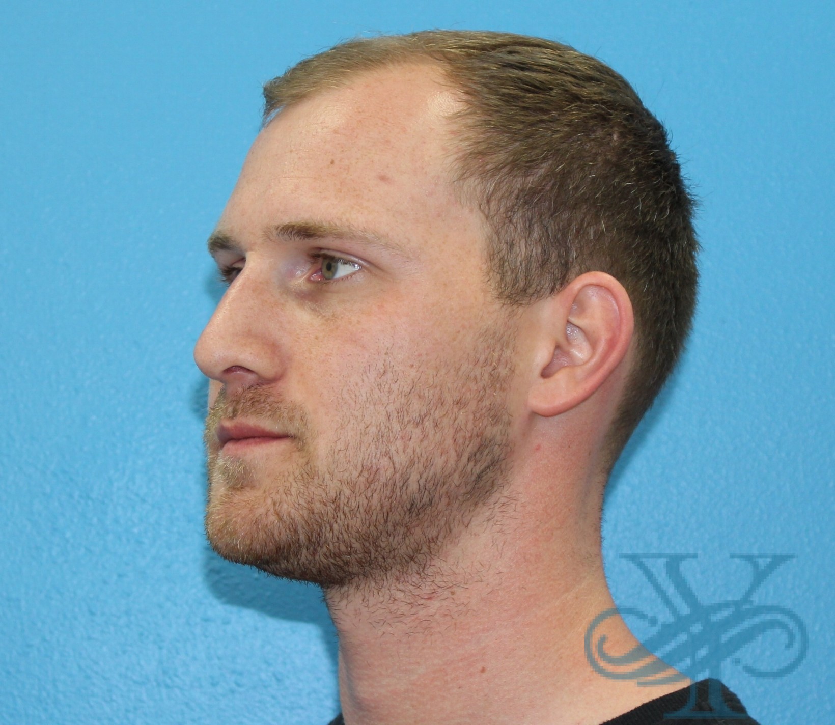 After rhinoplasty Dr. Yegiyants, Santa Barbara, CA