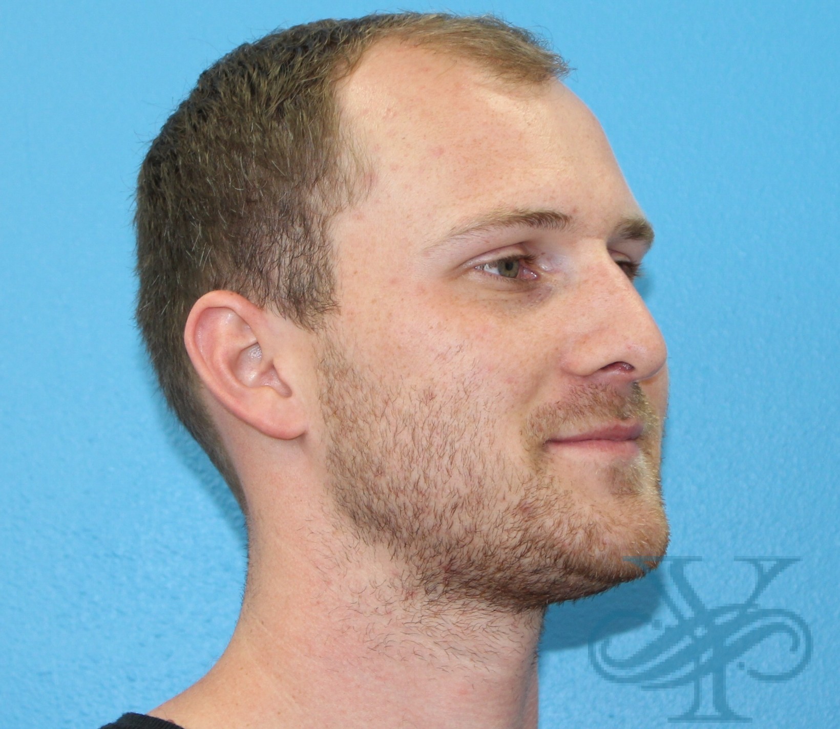 After rhinoplasty Dr. Yegiyants, Santa Barbara, CA
