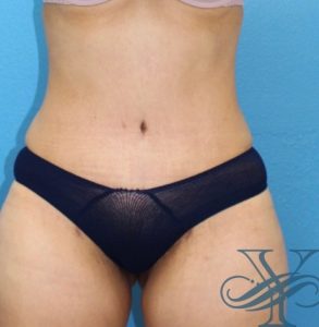 After abdominoplasty Dr. Yegiyants, Santa Barbara, CA