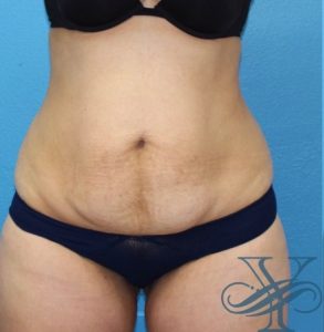 Before abdominoplasty Dr. Yegiyants, Santa Barbara, CA