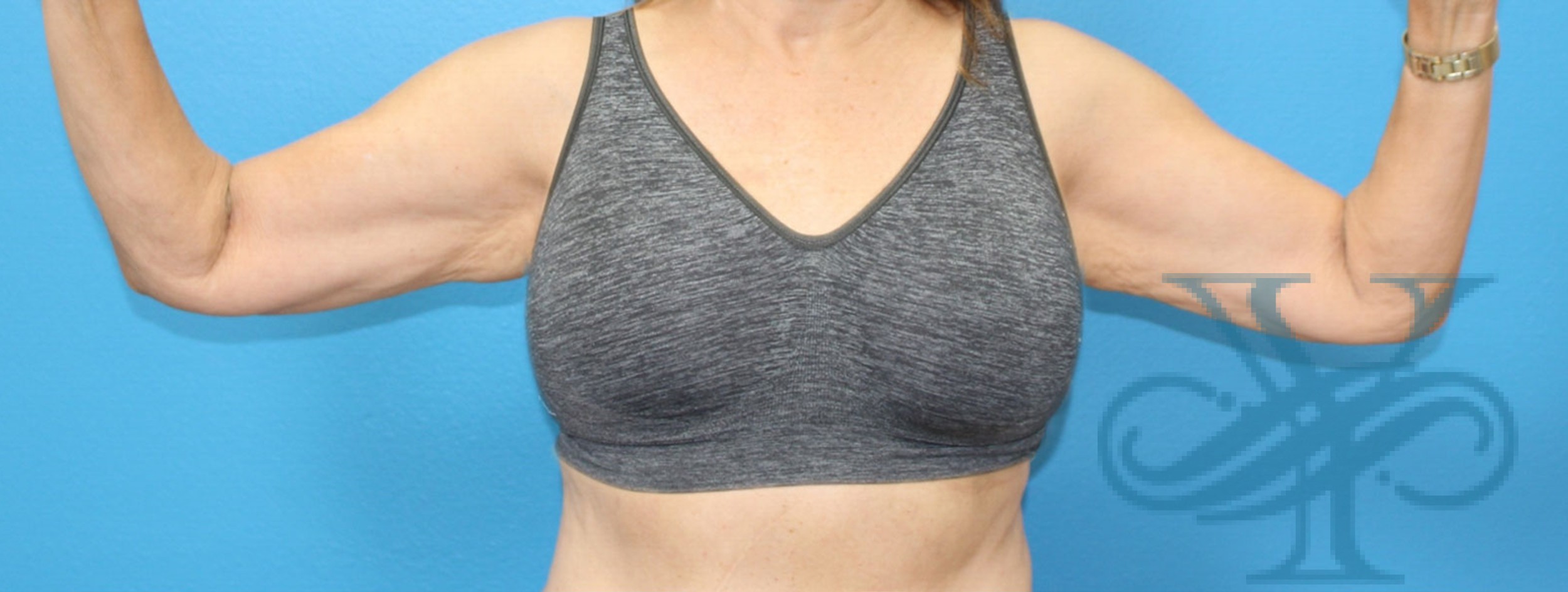 Before brachioplasty Dr. Yegiyants, Santa Barbara, CA