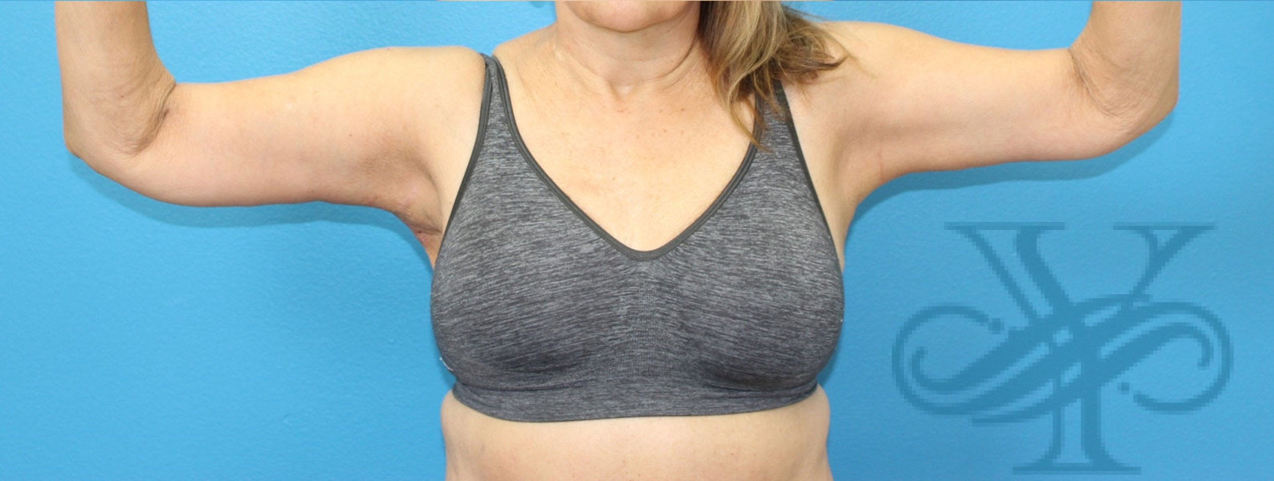 After brachioplasty Dr. Yegiyants, Santa Barbara, CA