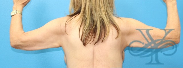 Before brachioplasty Dr. Yegiyants, Santa Barbara, CA