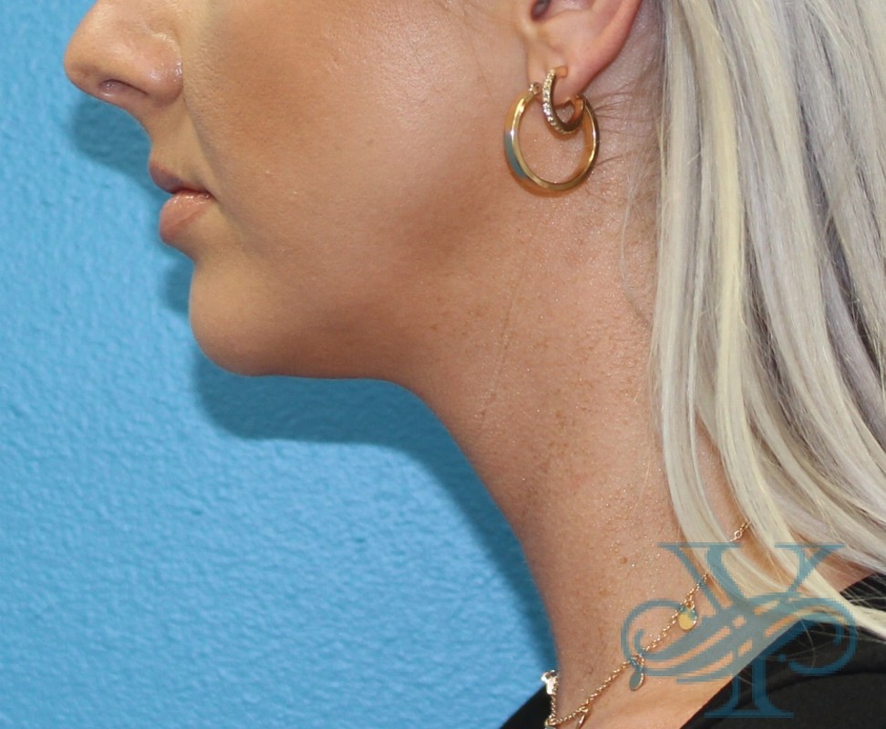 After Kybella Dr. Yegiyants, Santa Barbara, CA