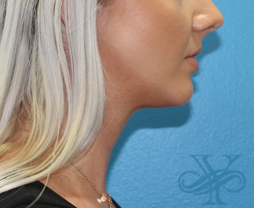 After Kybella Dr. Yegiyants, Santa Barbara, CA