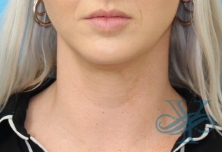 Before Kybella Dr. Yegiyants, Santa Barbara, CA