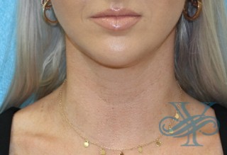 After Kybella Dr. Yegiyants, Santa Barbara, CA