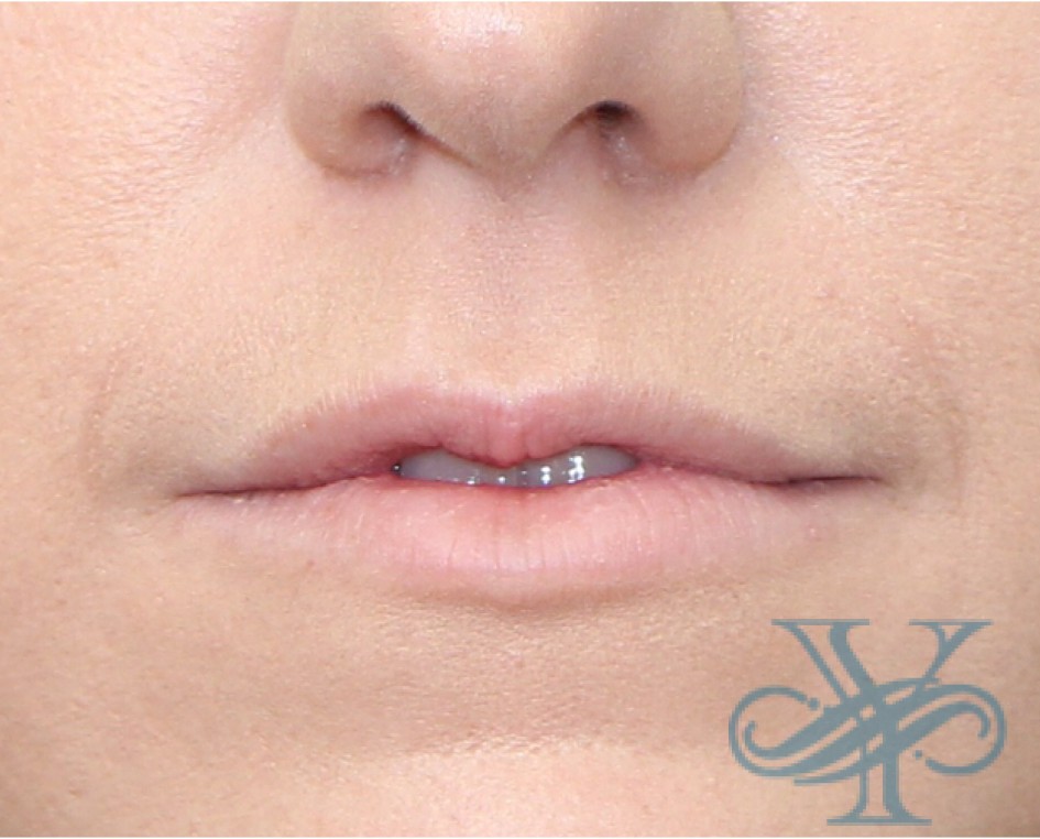 Before lip fillers Dr. Yegiyants, Santa Barbara, CA