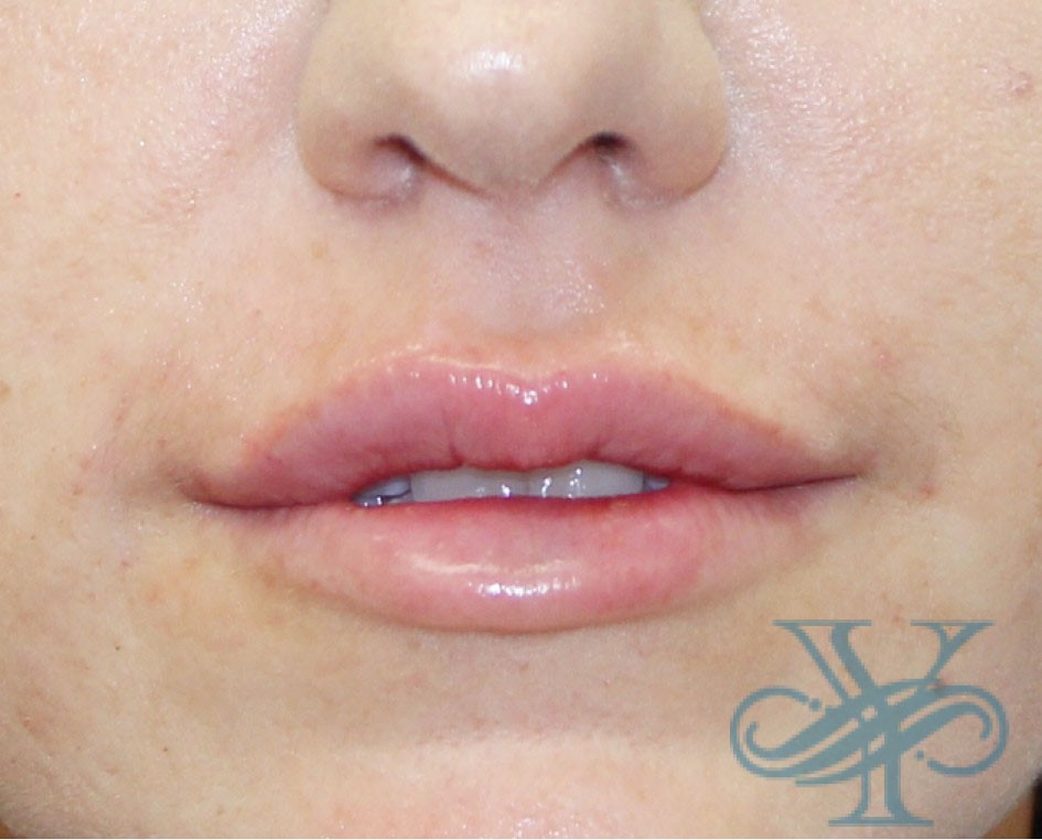 after lip fillers Dr. Yegiyants, Santa Barbara, CA