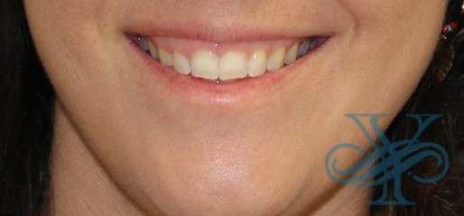 After liposuction Dr. Yegiyants, Santa Barbara, CA