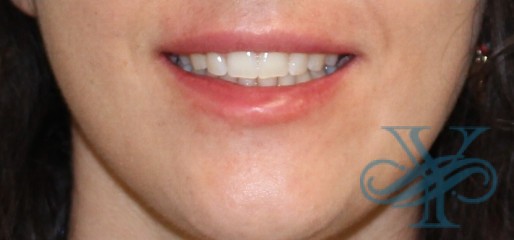 Before liposuction Dr. Yegiyants, Santa Barbara, CA