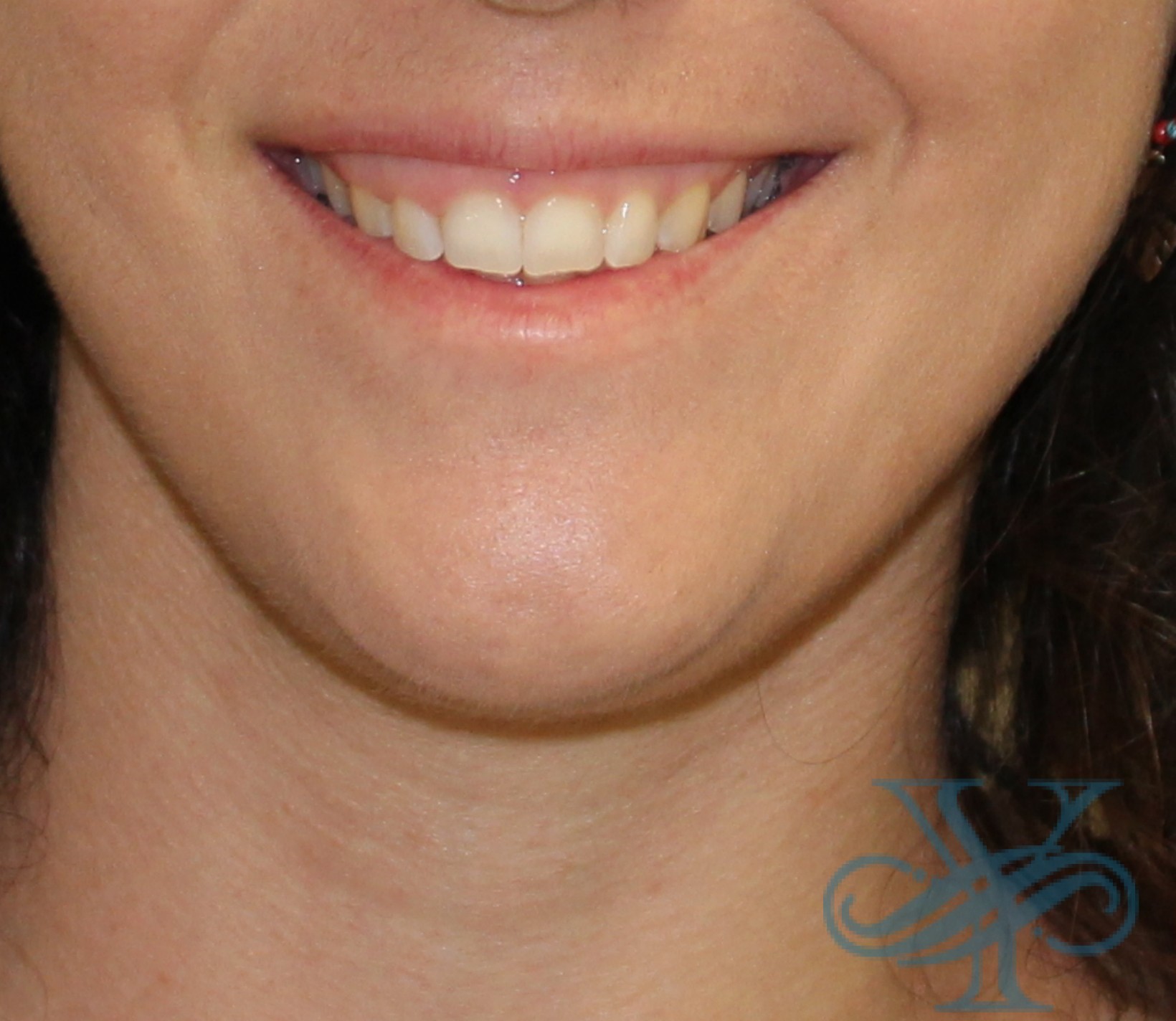 Before lip filler Dr. Yegiyants, Santa Barbara, CA