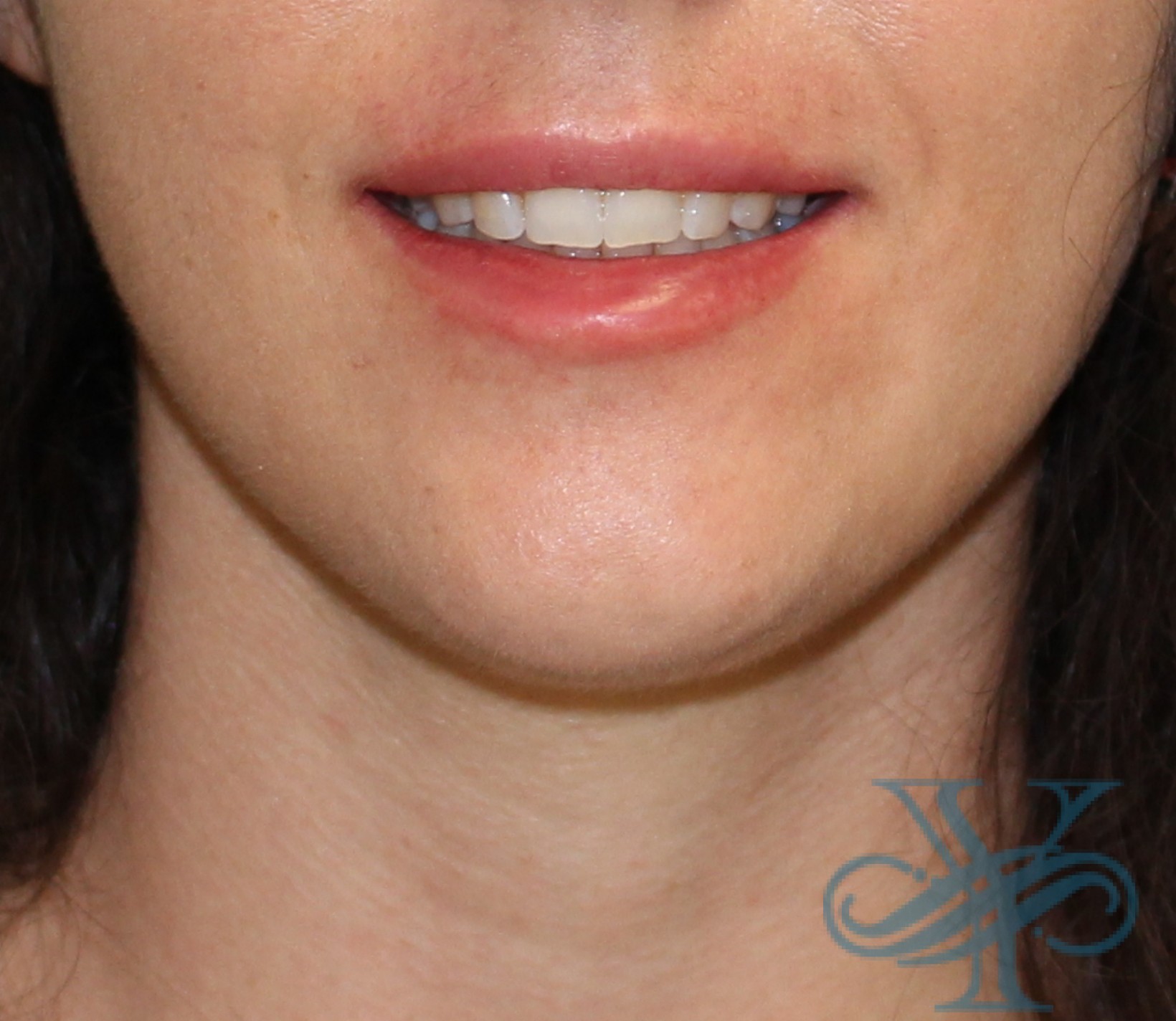 after lip fillers Dr. Yegiyants, Santa Barbara, CA
