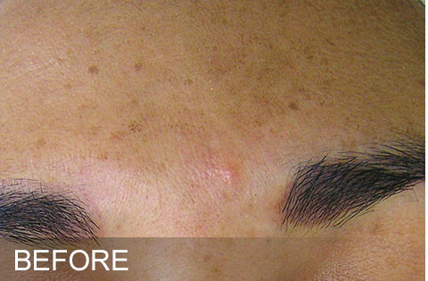 Before hydrafacaial Dr. Yegiyants, Santa Barbara, CA