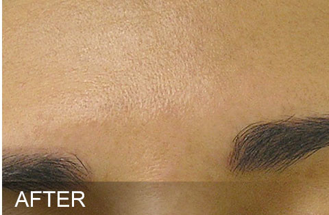 After hydrafacial Dr. Yegiyants, Santa Barbara, CA