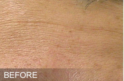 Before hydrafacaial Dr. Yegiyants, Santa Barbara, CA
