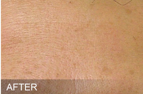 After hydrafacial Dr. Yegiyants, Santa Barbara, CA