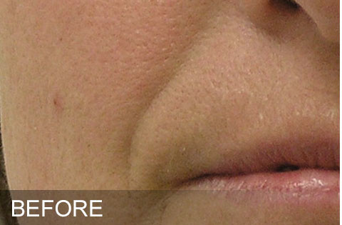 Before hydrafacaial Dr. Yegiyants, Santa Barbara, CA