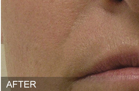 After hydrafacial Dr. Yegiyants, Santa Barbara, CA