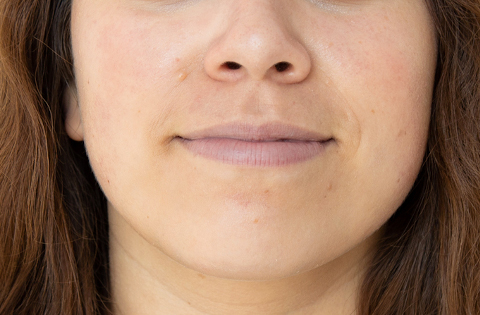 After hydrafacial Dr. Yegiyants, Santa Barbara, CA