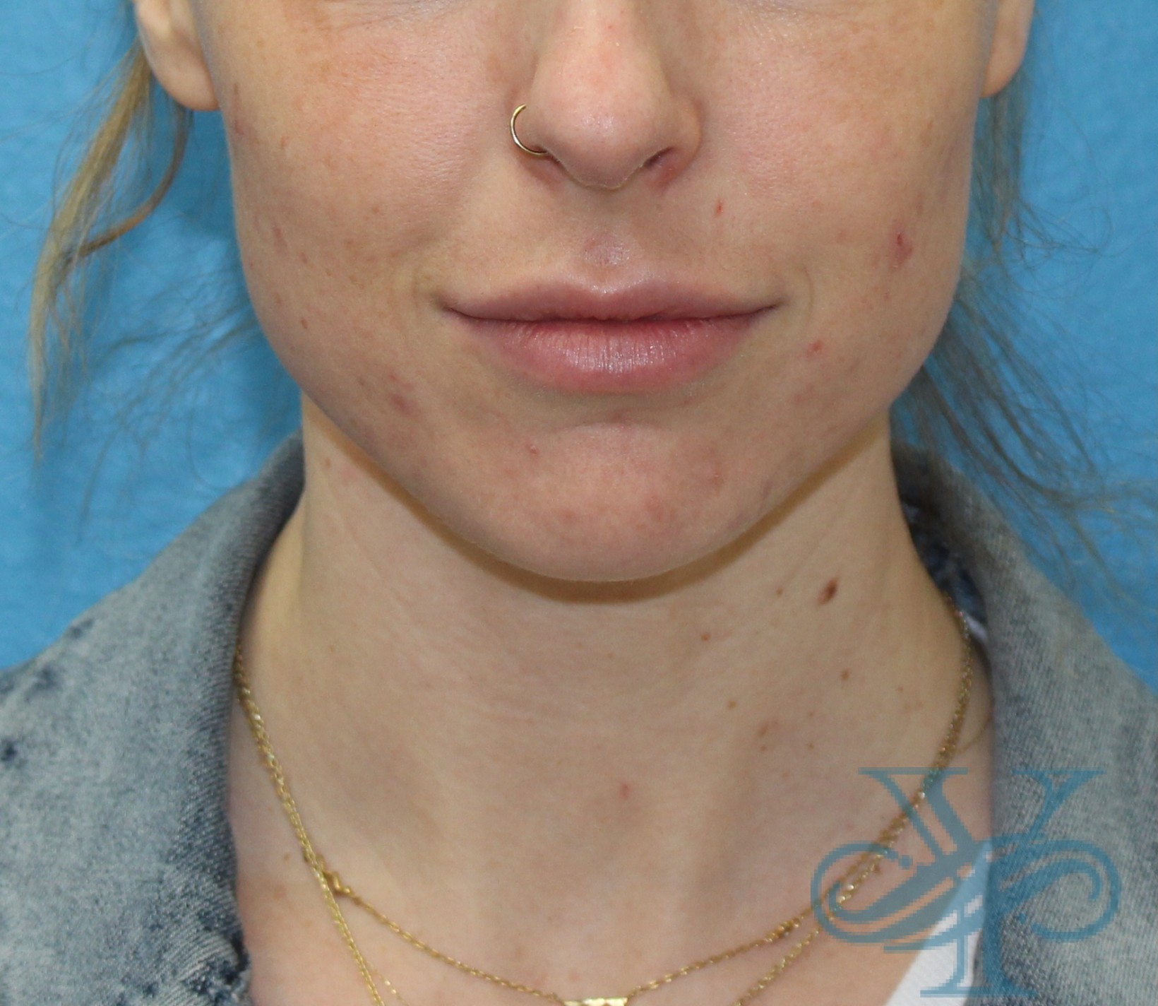 Before laser treatment Dr. Yegiyants, Santa Barbara, CA