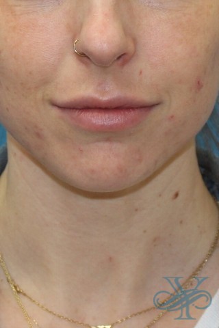 Before laser treatment Dr. Yegiyants, Santa Barbara, CA