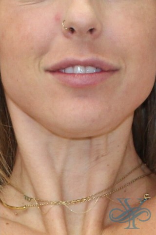 After laser treatment Dr. Yegiyants, Santa Barbara, CA