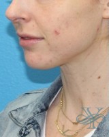 Before laser treatment Dr. Yegiyants, Santa Barbara, CA