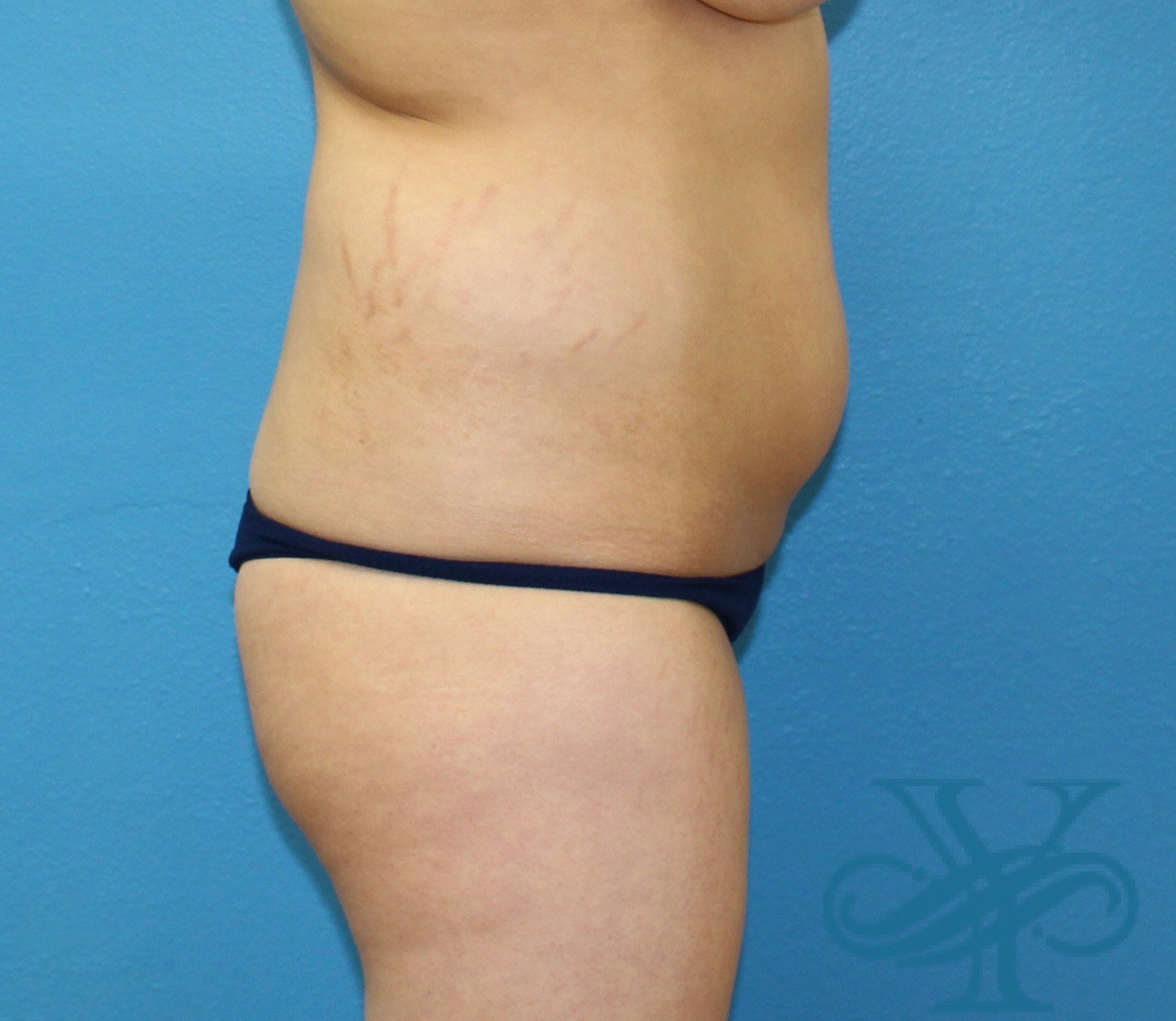Before liposuction Dr. Yegiyants, Santa Barbara, CA