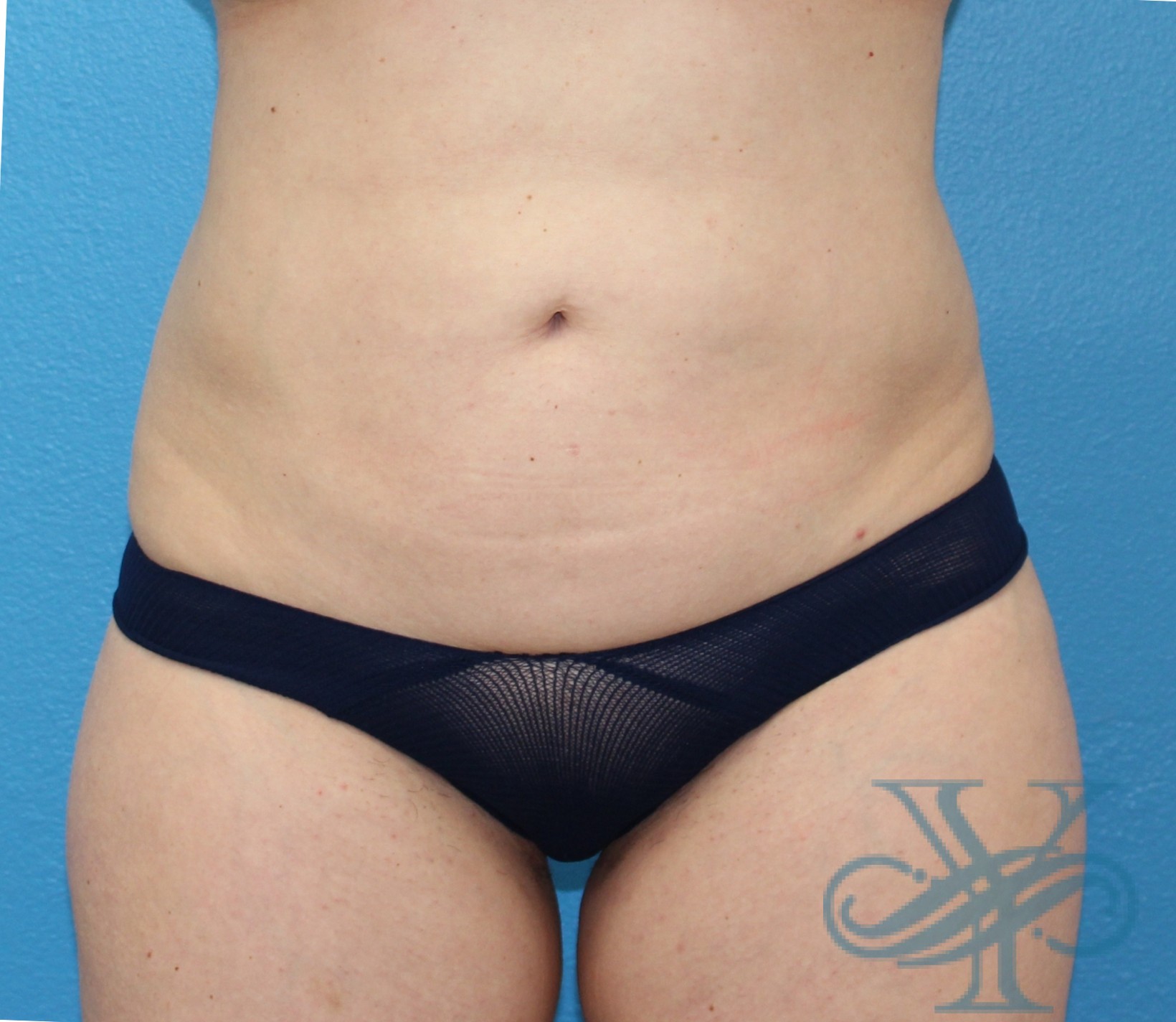Before liposuction Dr. Yegiyants, Santa Barbara, CA