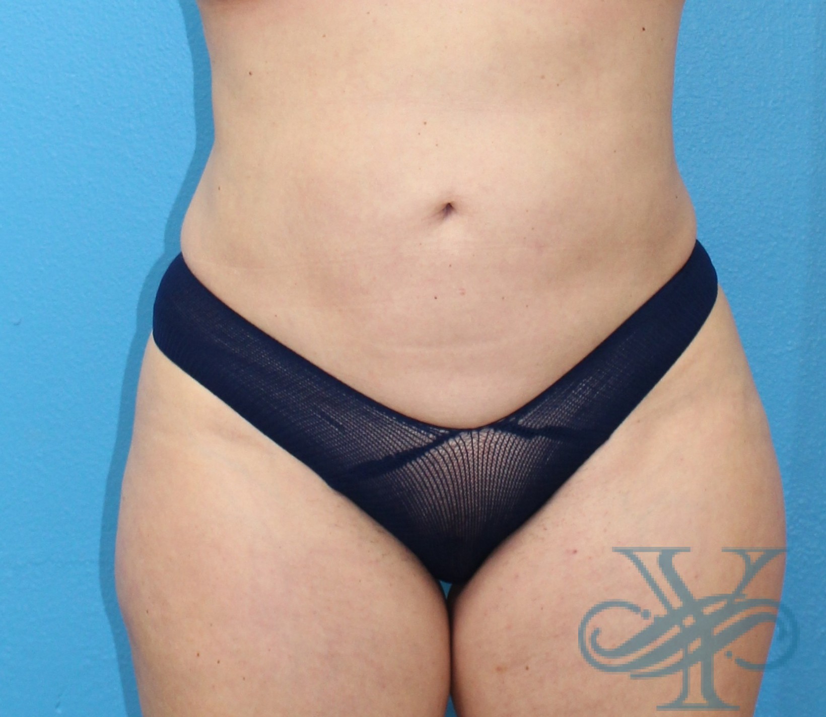 After liposuction Dr. Yegiyants, Santa Barbara, CA