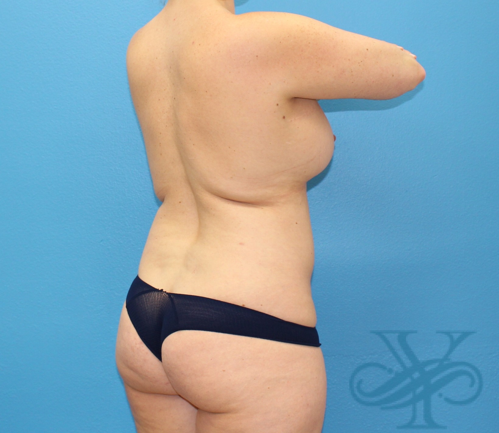 Before liposuction Dr. Yegiyants, Santa Barbara, CA