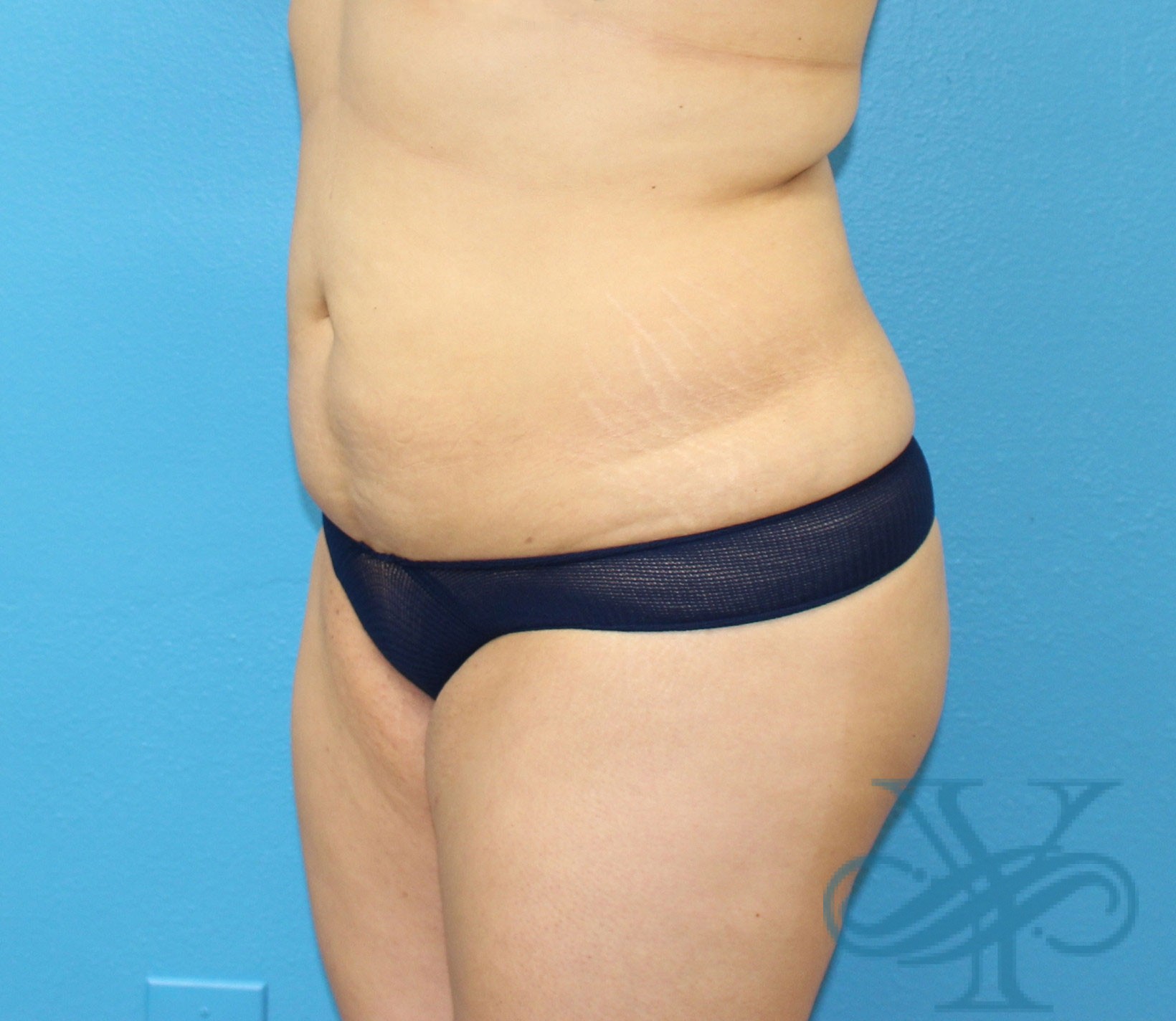 Before liposuction Dr. Yegiyants, Santa Barbara, CA