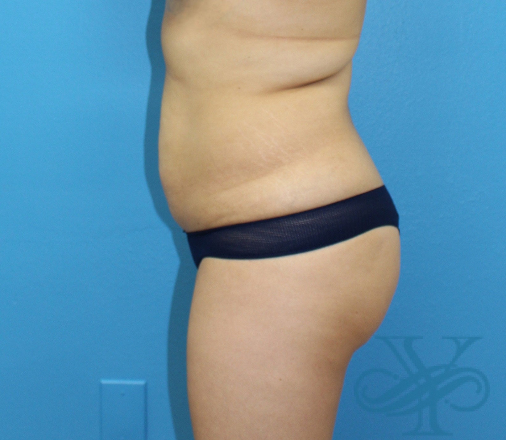 Before liposuction Dr. Yegiyants, Santa Barbara, CA