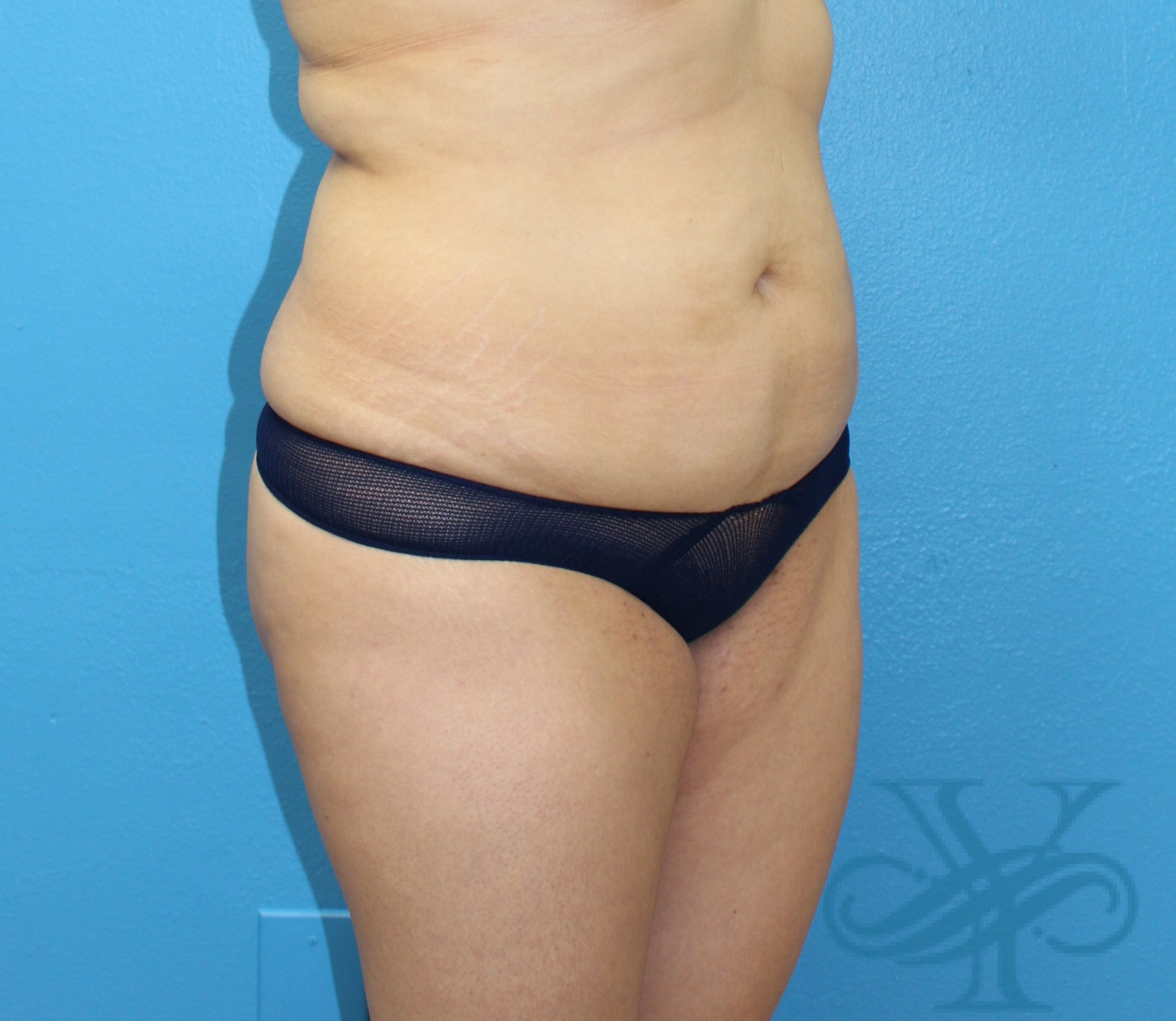 Before liposuction Dr. Yegiyants, Santa Barbara, CA