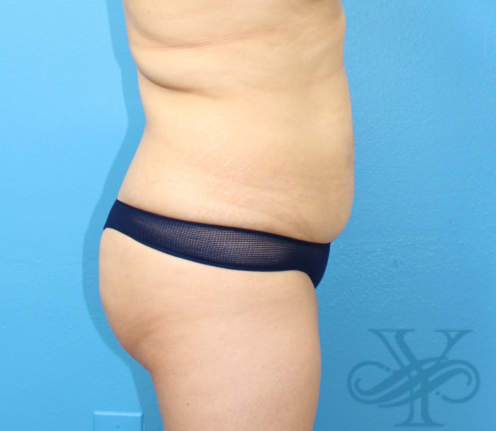 Before liposuction Dr. Yegiyants, Santa Barbara, CA