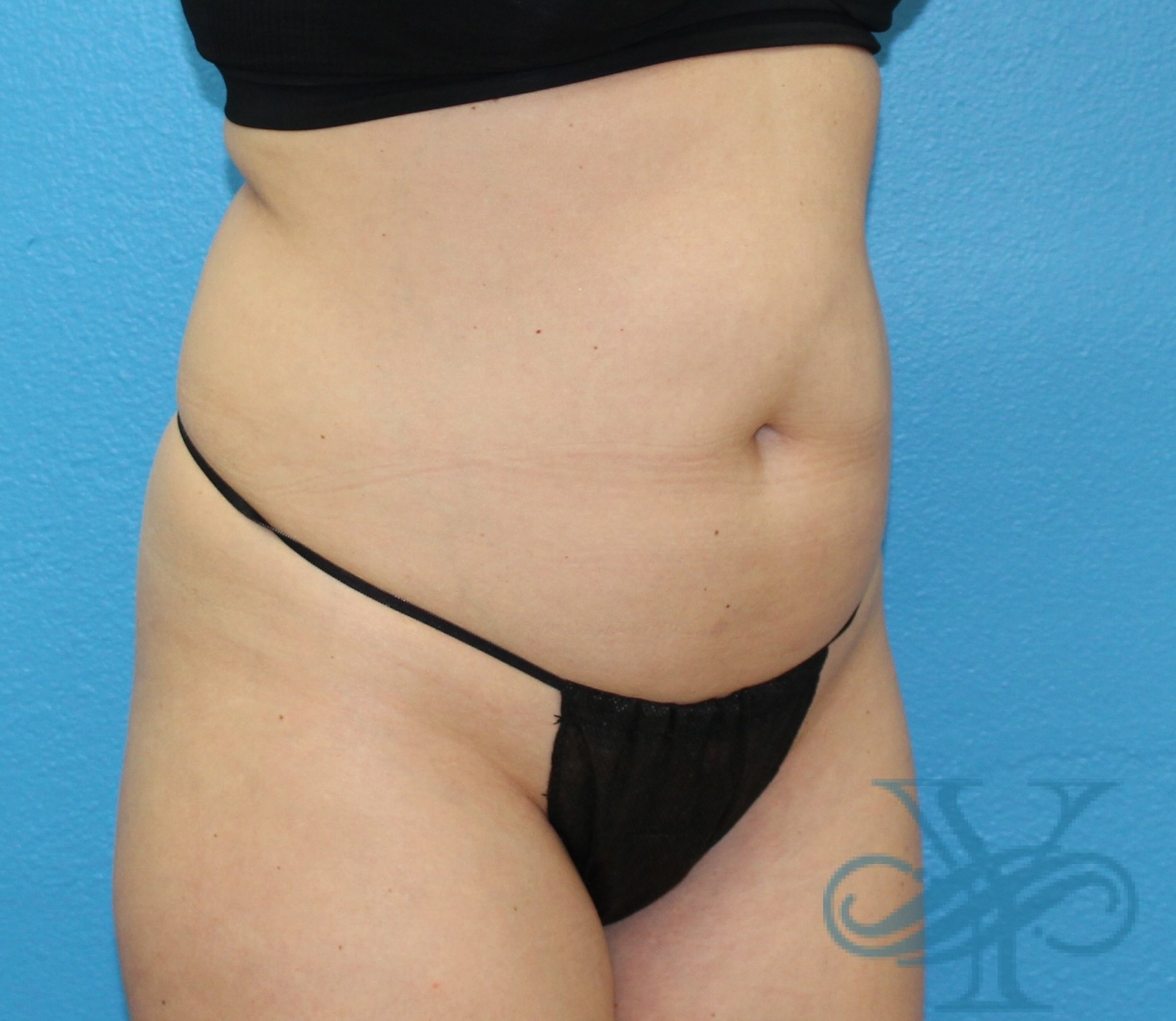 Before sculpsure Dr. Yegiyants, Santa Barbara, CA