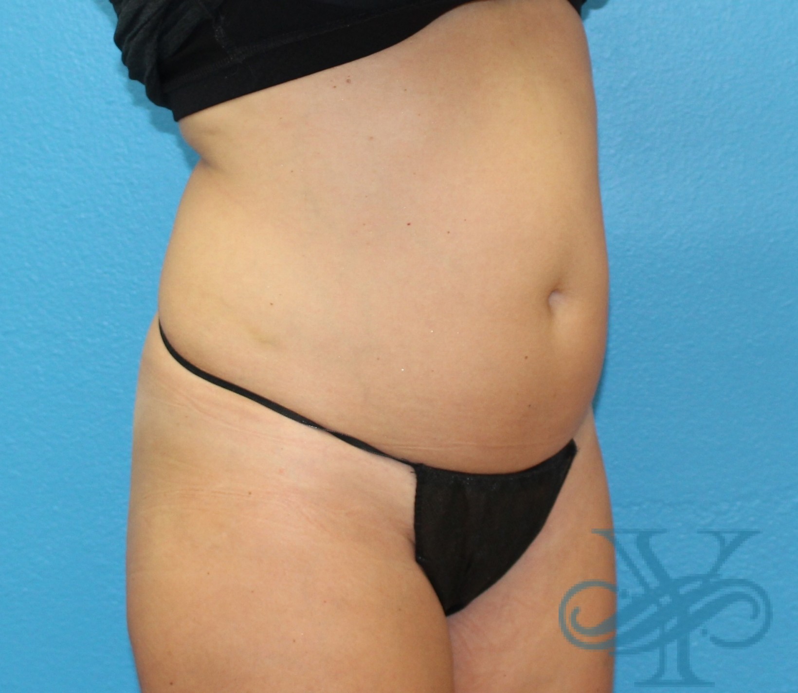 After sculpsure Dr. Yegiyants, Santa Barbara, CA