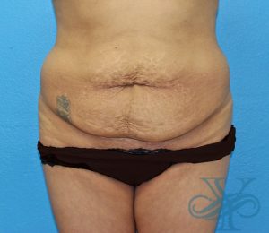 front view of patient before tummy tuck