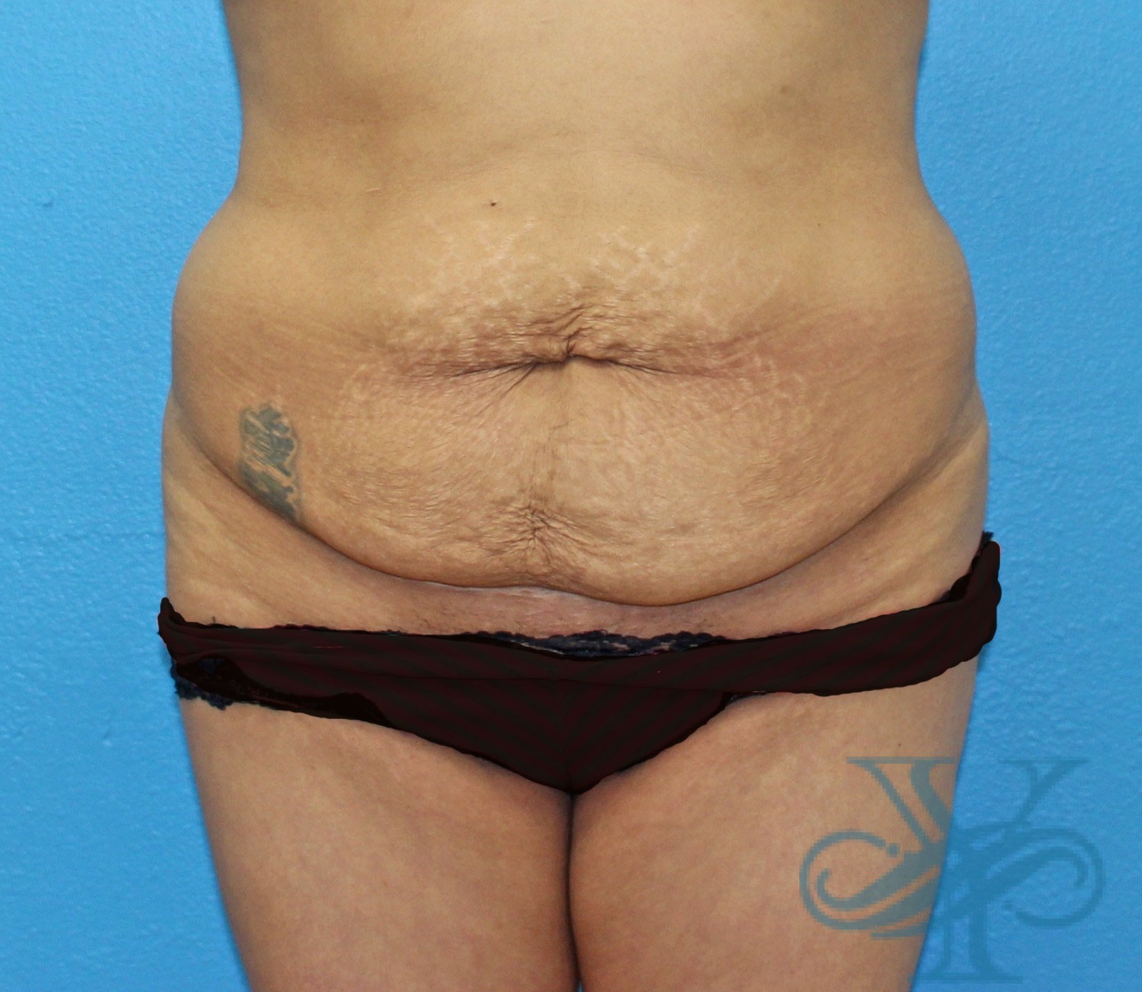 front view of patient before tummy tuck