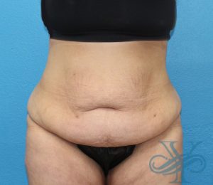 before abdominoplasty front view